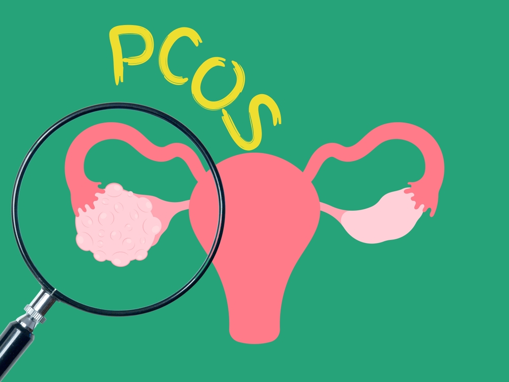 PCOS – jak rozpoznać objawy i które badania hormonalne wykonać?